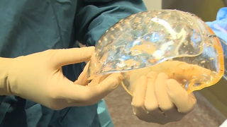 Watch a Woman Get a New 3D-Printed Skull